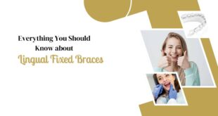 Everything-You-Should-Know-about-Lingual-Fixed-Braces