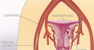 Adenomyosis Treatment in UAE