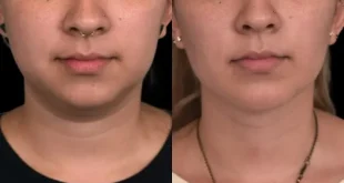 Double Chin Removal