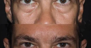 Eye Bag Removal