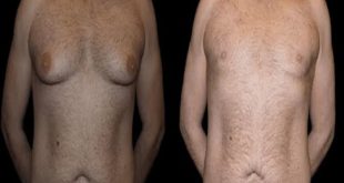 Before and After Male Breast Reduction Result