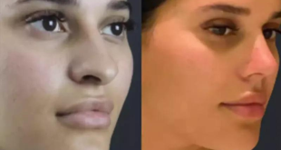 Achieve Your Ideal Nose with Rhinoplasty in Dubai Experts