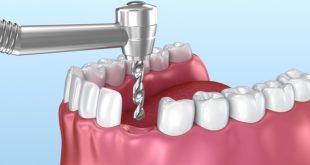 dental implants image