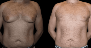 male breast reduction with before and after photos