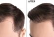 Hair Transplant in Pakistan