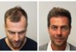 Best Hair Transplant Clinics in London for Quality & Price