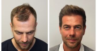 Best Hair Transplant Clinics in London for Quality & Price