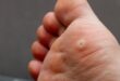 How do you remove the plantar wart on the bottom of the foot?