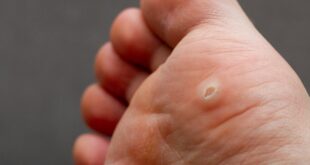 How do you remove the plantar wart on the bottom of the foot?