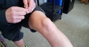 Suprapatellar Bursitis