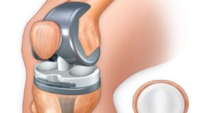 Knee Replacement Surgery Cost in Pakistan