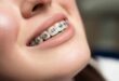 how do braces actually work?