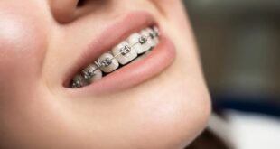 how do braces actually work?